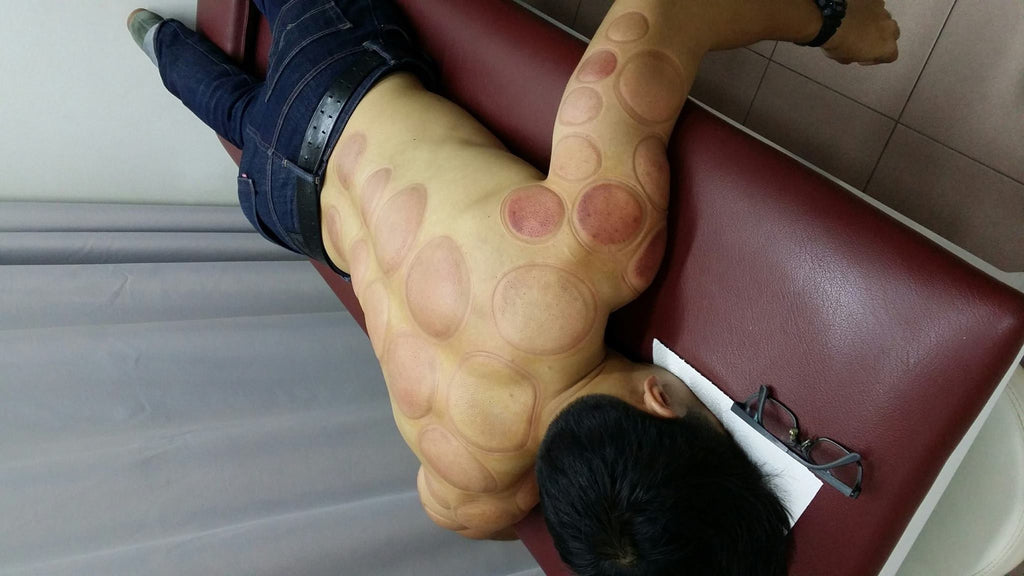 Cupping to combat stress related symptons